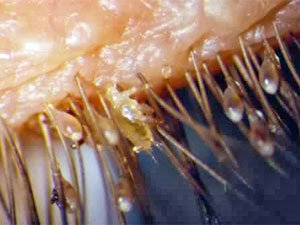 What are the symptoms of mite infestation in humans?