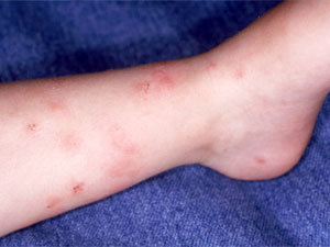Flea allergy dermatitis